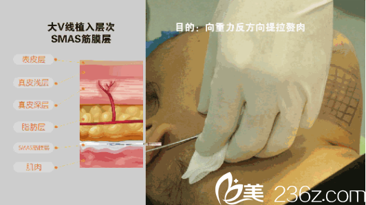 線雕植入過程 線雕植入過程