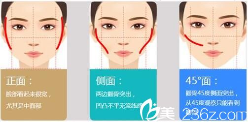 磨顴骨手術(shù)原理