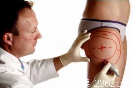 大腿抽脂多久能走路