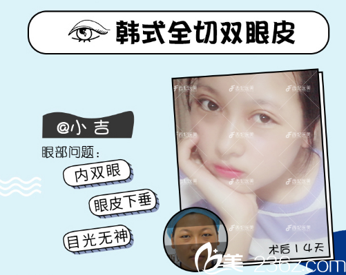 東莞南城西妃全切雙眼皮效果圖