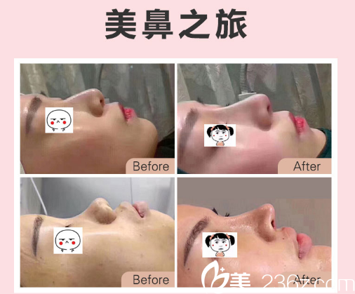 東莞南城西妃鼻綜合隆鼻效果圖