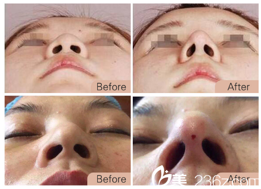 東莞南城西妃隆鼻效果圖