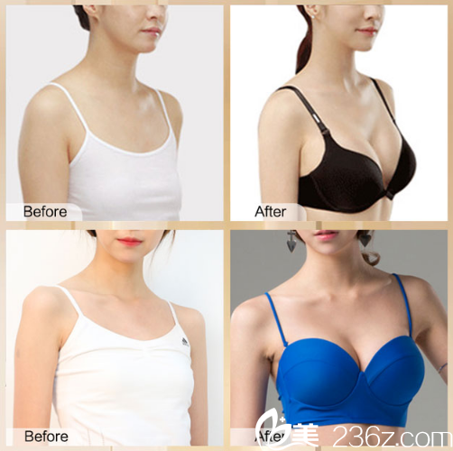 東莞南城西妃假體隆胸效果圖