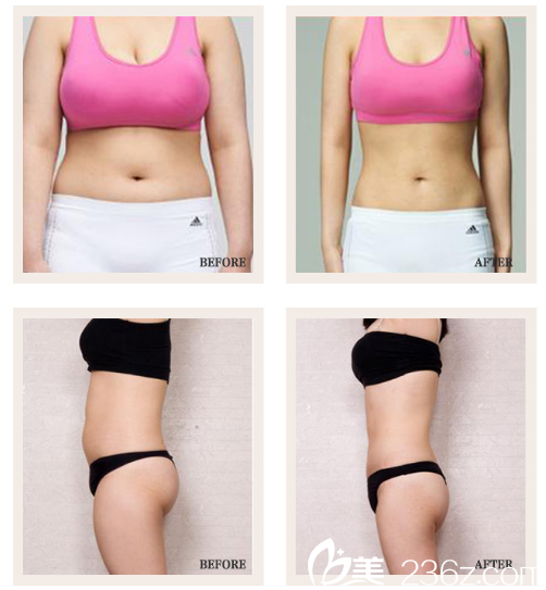 東莞南城西妃戴新明做的吸脂效果圖