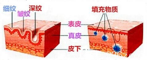 玻尿酸填充法令紋原理