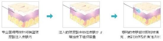 玻尿酸填充法令紋
