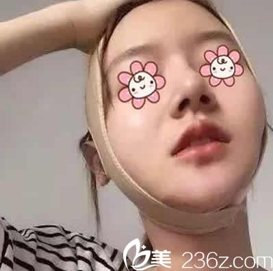 我在運(yùn)城華美整形做全臉線雕提升后第3天照片 我在運(yùn)城華美整形做全臉線雕提升后第3天照片