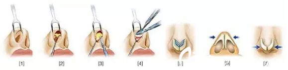 鼻翼縮小手術流程
