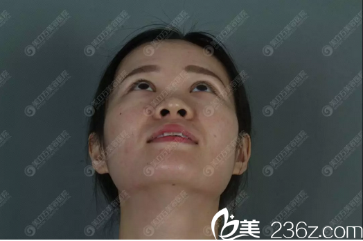 隆鼻術(shù)前仰視圖 隆鼻術(shù)前仰視圖