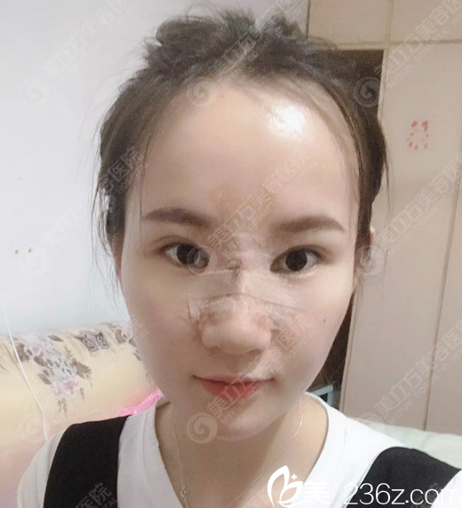 東莞美立方鄭志敏隆鼻術(shù)后7天照片 東莞美立方鄭志敏隆鼻術(shù)后7天照片