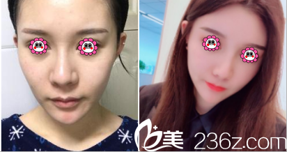 北京美萊魯峰面部脂肪填充案例 北京美萊魯峰面部脂肪填充案例