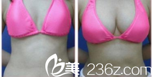 北京美萊魯峰脂肪豐胸案例 北京美萊魯峰脂肪豐胸案例
