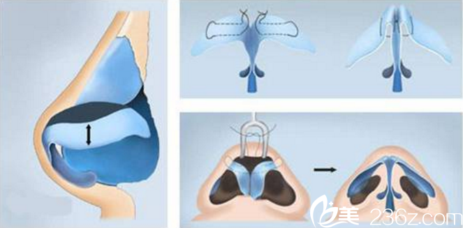 蒜頭鼻矯正方法