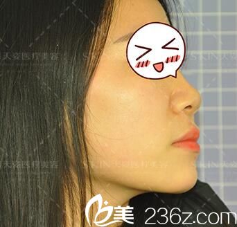 做鼻綜合術(shù)前照 做鼻綜合術(shù)前照