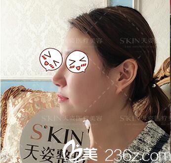 在天姿做鼻綜合術(shù)后30天<span style= 在天姿做鼻綜合術(shù)后30天<span style=