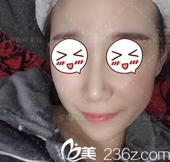 在天姿整形醫(yī)院做鼻綜合術(shù)后60天恢復(fù)情況 在天姿整形醫(yī)院做鼻綜合術(shù)后60天恢復(fù)情況