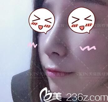 懷化天姿整形美容醫(yī)院隆鼻怎么樣？看我做的鼻綜合術(shù)后85天恢復(fù)效果就知道了！