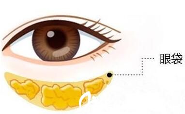 眼袋的形成及祛除介紹