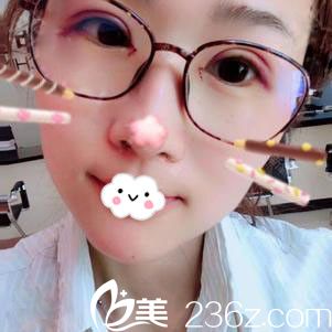 隨州奧萊雙眼皮+開眼角術后效果