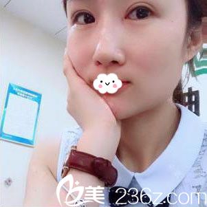 隨州奧萊切開雙眼皮+開內(nèi)眼角效果怎么樣