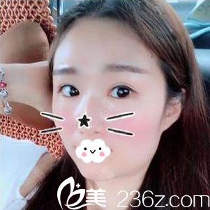 假期我到隨州奧萊醫(yī)療美容張志田處做雙眼皮+開眼角整形了