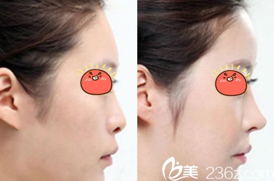 臺(tái)州昊陽(yáng)整形<!--<i data=20240703-sp></i>-->鼻綜合隆鼻 臺(tái)州昊陽(yáng)整形<!--<i data=20240703-sp></i>-->鼻綜合隆鼻