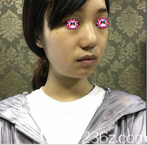 在北京華韓做熱瑪吉美膚前樣子 在北京華韓做熱瑪吉美膚前樣子