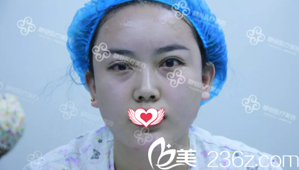 剛做完脂肪填充面部后腫脹 剛做完脂肪填充面部后腫脹