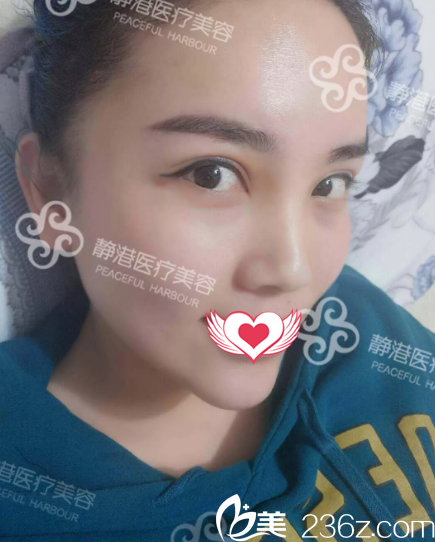 面部蒼老的我找滄州靜港季澤東院長(zhǎng)做自體脂肪填充后瞬變妙齡少女