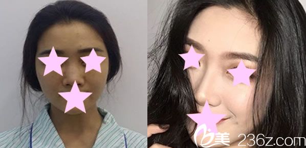 韓國愛她整形假體隆鼻代表案例