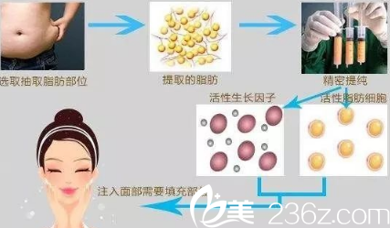 自體脂肪填充凹陷疤痕