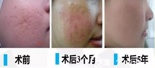 自體脂肪填充凹陷疤痕案例