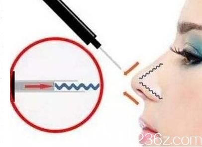 線雕隆鼻能持續(xù)多久？