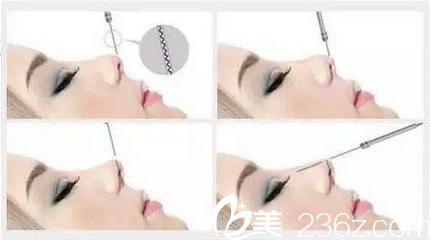 線雕隆鼻適合人群