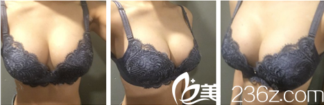 生育后胸部干癟 找韓國(guó)卓凱整形醫(yī)院趙镕賢醫(yī)生做假體豐胸后成超級(jí)辣媽