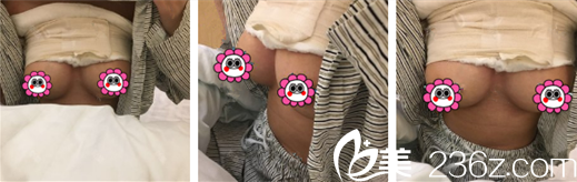 假體豐胸術(shù)后第二天 假體豐胸術(shù)后第二天