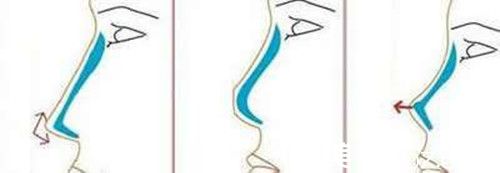 在南昌做假體隆鼻手術(shù)多少錢