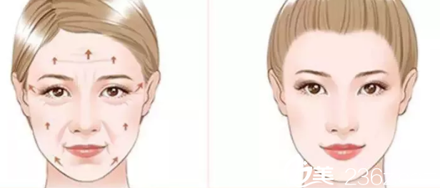 面部埋線提升效果示意圖