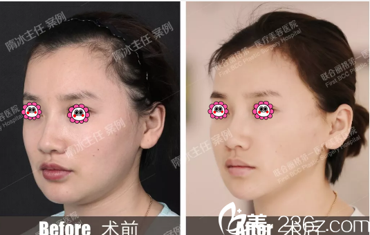 北京聯(lián)合麗格隋冰醫(yī)生線雕案例