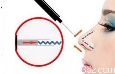 線雕隆鼻注意事項(xiàng)