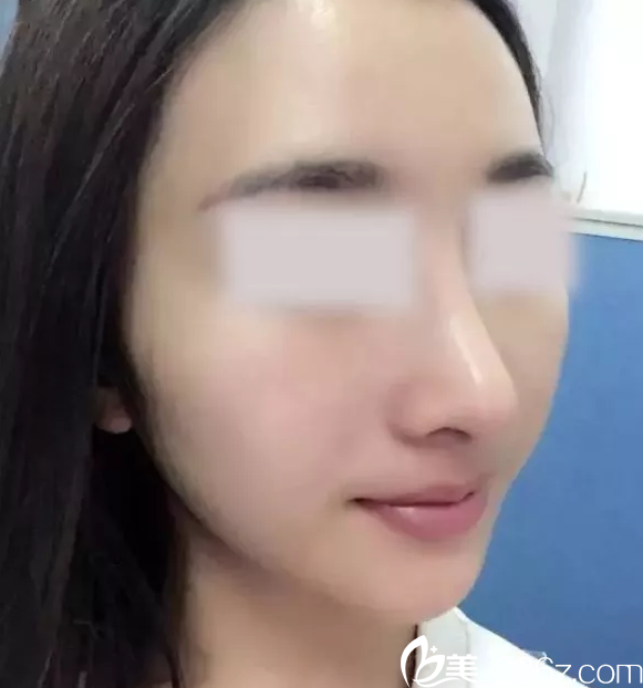 術(shù)后半個月的效果