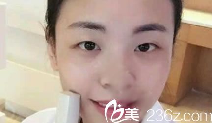 在黃巖昊陽整形割雙眼皮前 在黃巖昊陽整形割雙眼皮前