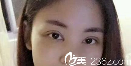 做完雙眼皮和開眼角5天恢復(fù)照 做完雙眼皮和開眼角5天恢復(fù)照