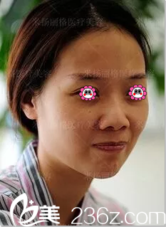 在北京米揚(yáng)麗格做隆鼻前樣子 在北京米揚(yáng)麗格做隆鼻前樣子