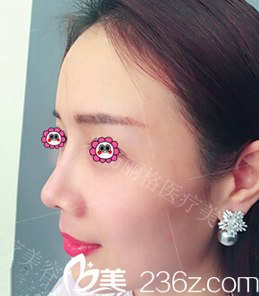 巫文云鼻整形技術(shù)好不好？參考我在米揚(yáng)麗格做自體軟骨鼻綜合隆鼻效果價(jià)格