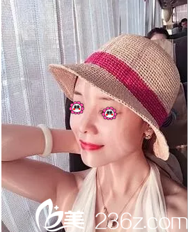 北京米揚(yáng)麗格巫文云自體軟骨鼻綜合隆鼻案例 北京米揚(yáng)麗格巫文云自體軟骨鼻綜合隆鼻案例