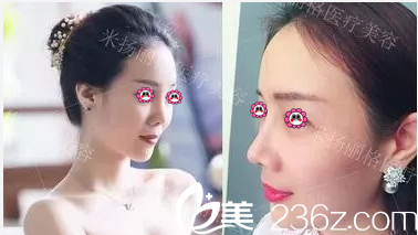 北京米揚(yáng)麗格找巫文云做隆鼻前后對比效果 北京米揚(yáng)麗格找巫文云做隆鼻前后對比效果