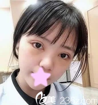 長(zhǎng)治悅美薛艷峰給我做切開(kāi)雙眼皮加開(kāi)內(nèi)眼角術(shù)后第7天拆線照片 長(zhǎng)治悅美薛艷峰給我做切開(kāi)雙眼皮加開(kāi)內(nèi)眼角術(shù)后第7天拆線照片