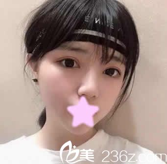 不知道和悅美哪個(gè)醫(yī)院好？沖著悅美整形價(jià)格實(shí)惠找薛艷峰做了全切雙眼皮+開(kāi)眼角