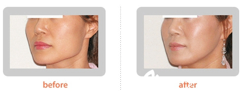 韓國(guó)橄欖整形外科下巴整形手術(shù)對(duì)比案例 韓國(guó)橄欖整形外科下巴整形手術(shù)對(duì)比案例